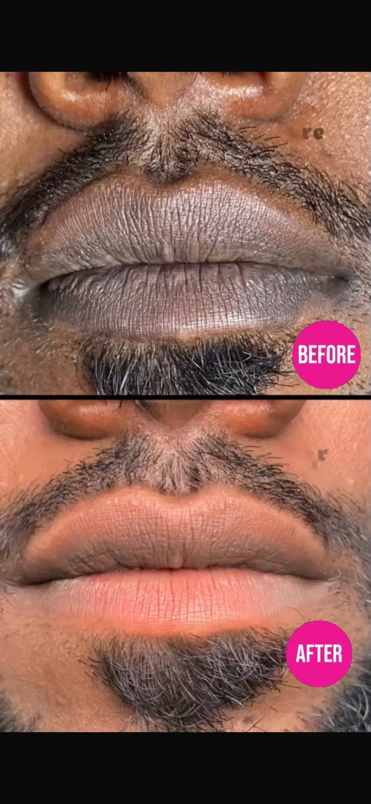 Customer lip care before and after photo